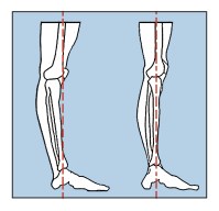 9-hyper-extended-knee